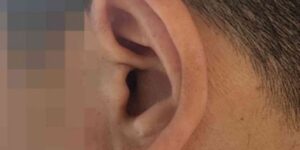 돌발성난청이 온 왼쪽 귀 사진으로 골든타임을 설명하기 위해 나의 실제 귀 사진을 썸네일 사진으로 활용