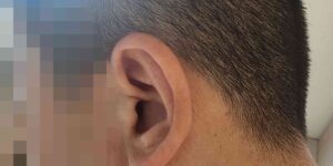 돌발성난청이 온 40대 남자의 왼쪽 귀 사진